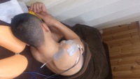 スノーボードなどでの転倒　腱板断裂